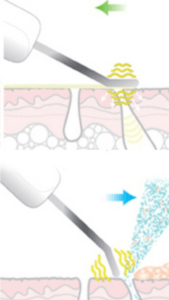Ultraschall Skin Scrubber