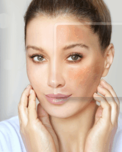 Pigmentflecken & unruhiger Teint – Natürliche Hautbildkorrektur